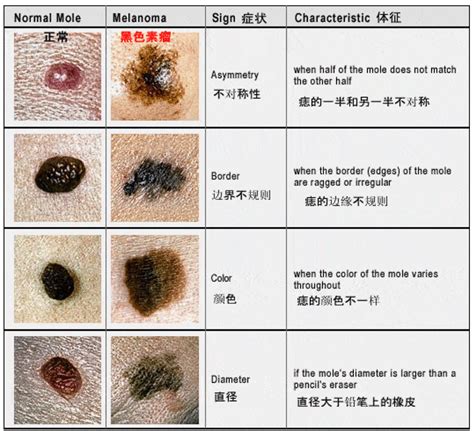 老二上有痣|痣也可能会癌变！长在 3 个地方要注意